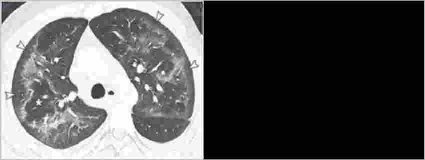 抽電子煙抽出肺泡