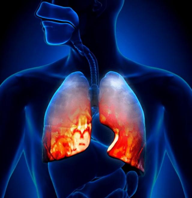 抽電子煙會使肺纖維化嗎？電子煙肺纖維化是怎么回事